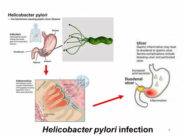 The link between ulcers and Helicobacter pylori infection