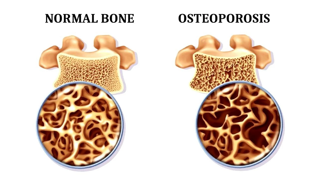 The impact of amiloride on bone health and osteoporosis