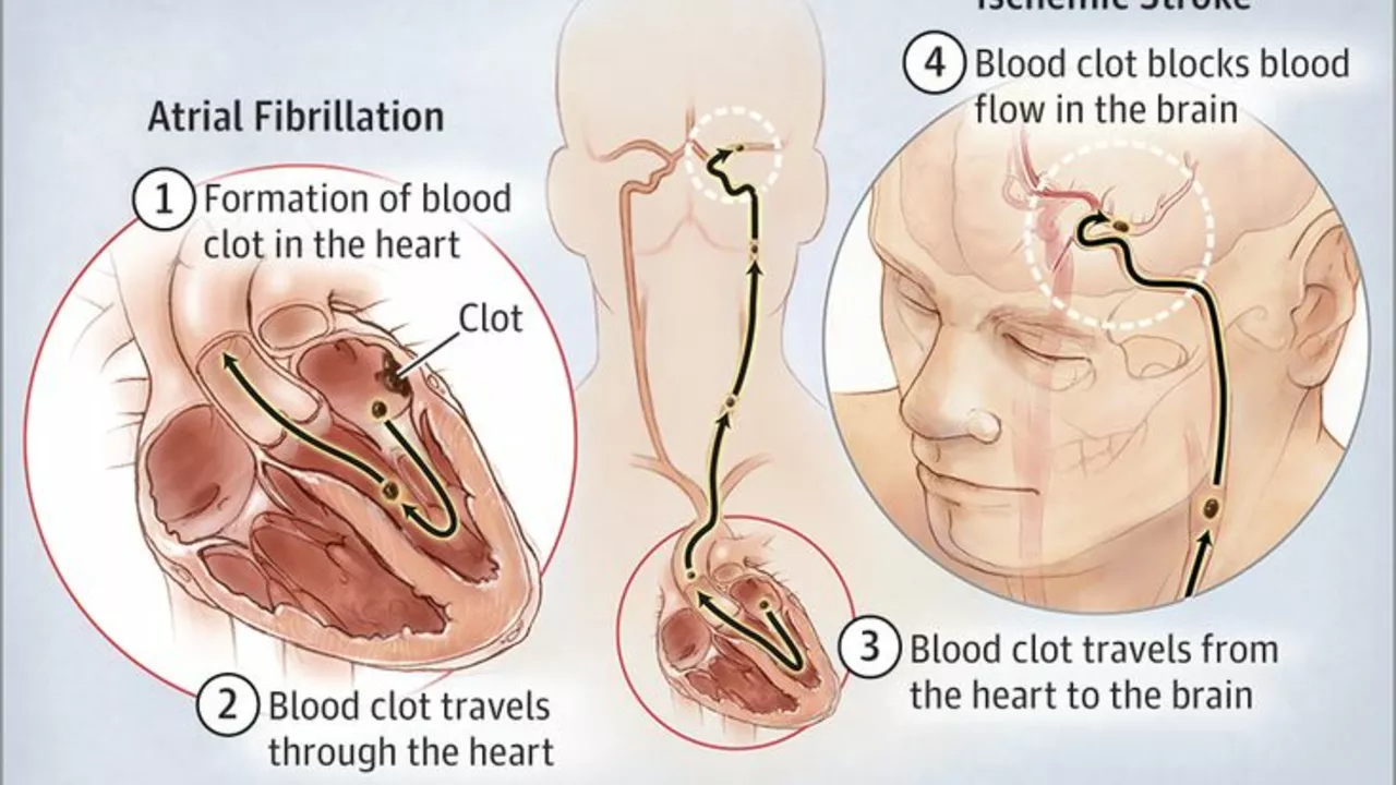 The Connection Between Blood Clots and Stroke